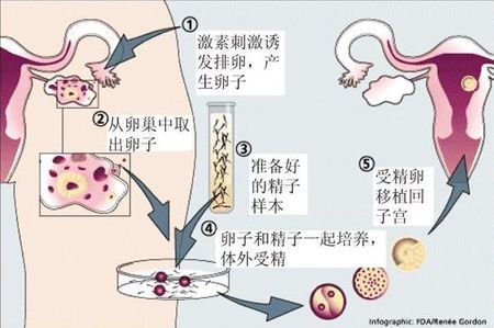 志愿者供卵咨询费用多少